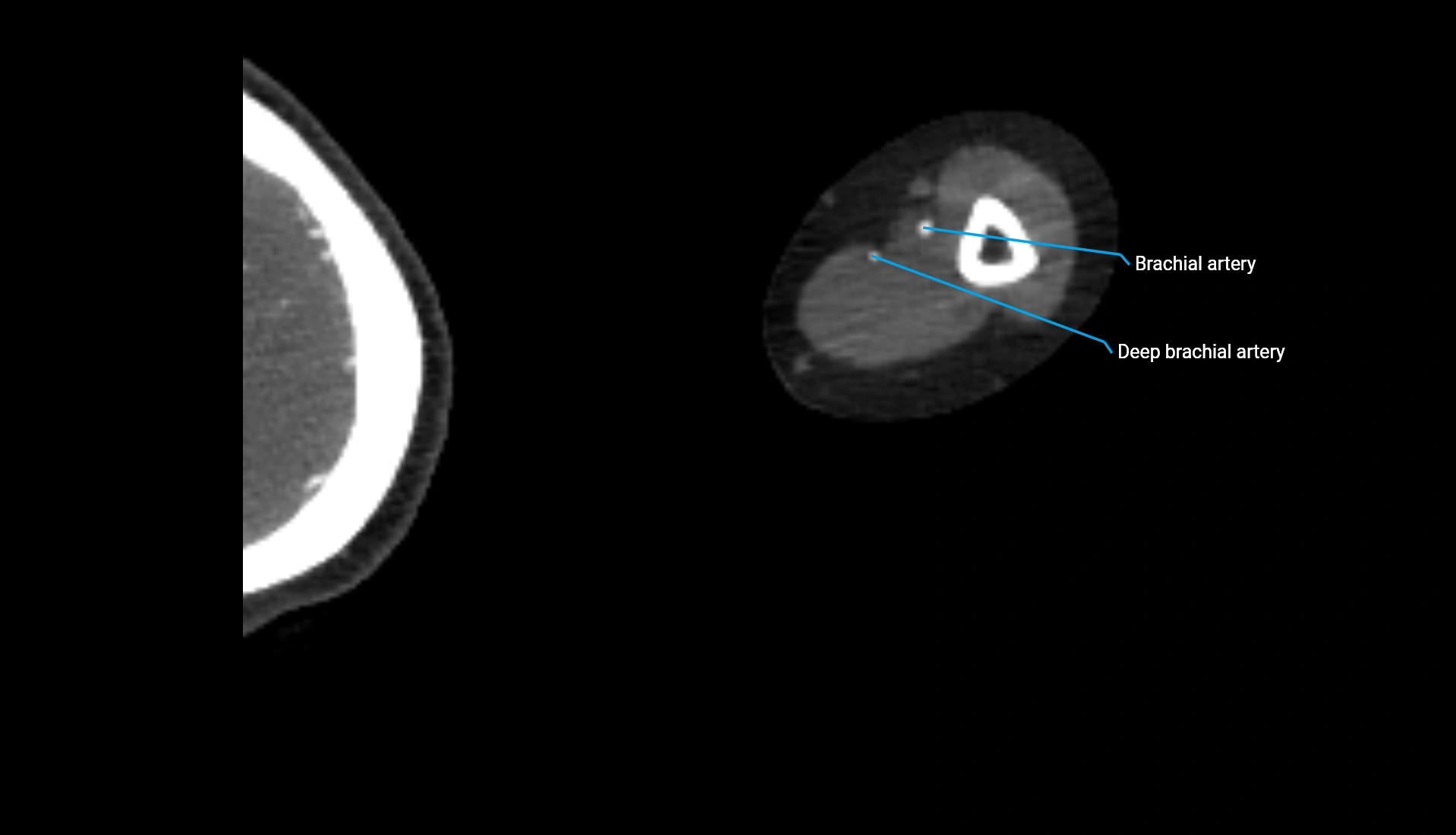 CTA upper limb axial cross sectional anatomy labelled image 218 (2).webp